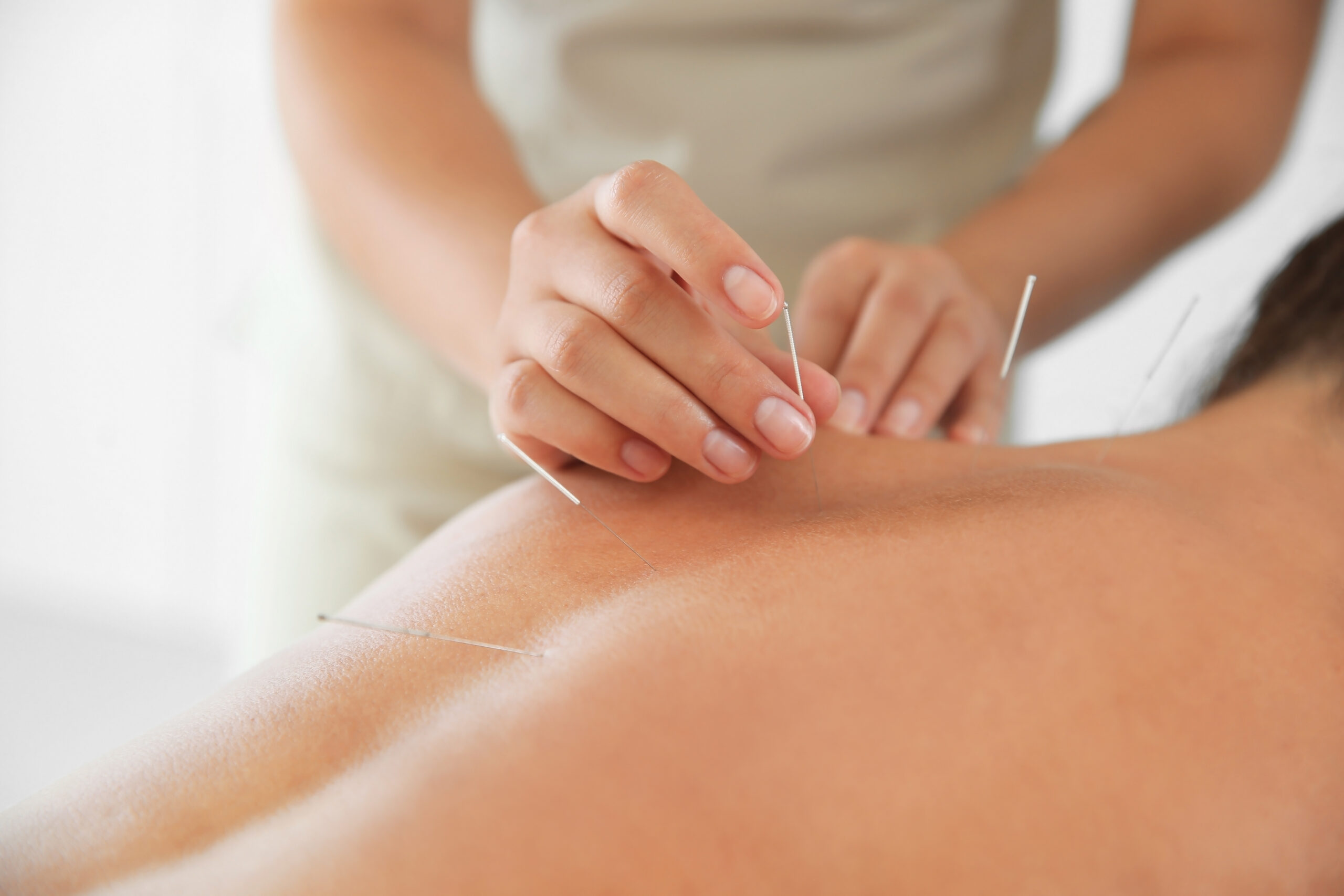 Young woman undergoing acupuncture treatment in salon, closeup